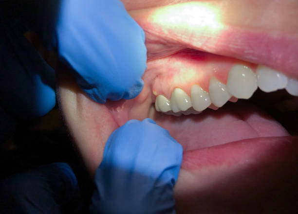 Best Emergency Tooth Extraction  in Mountain Green, UT